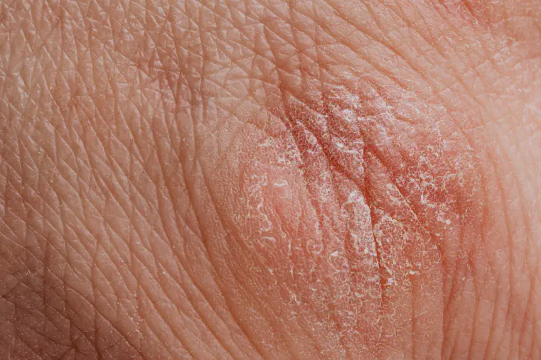 Dry Patches on Skin