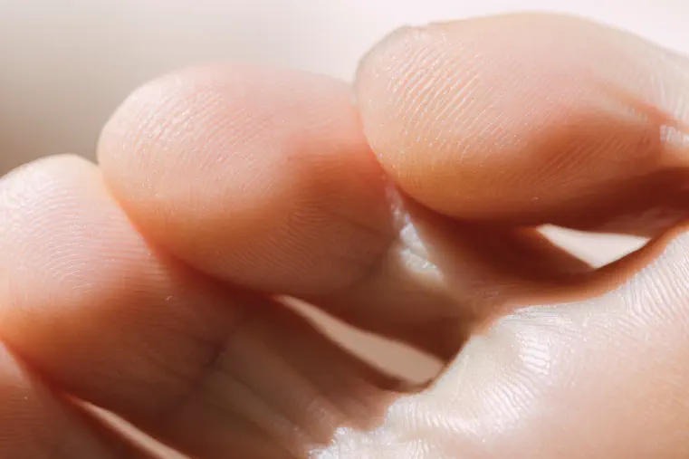 Dry Skin Between Toes