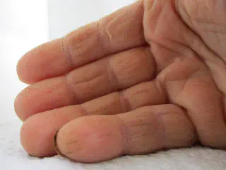 Skin Peel on Fingers